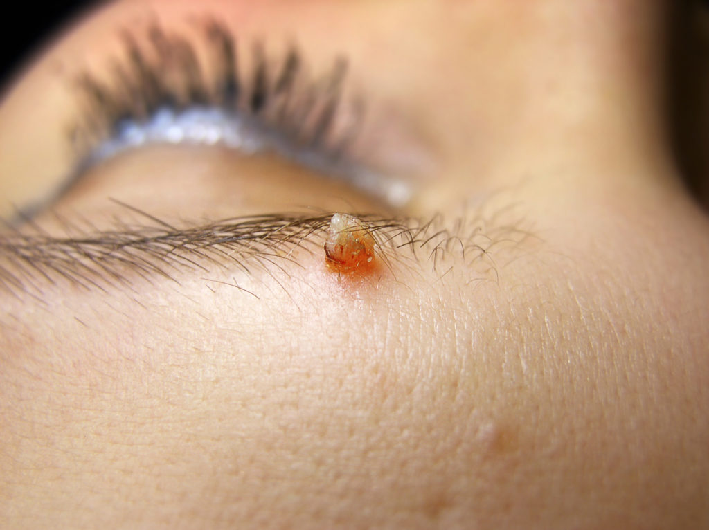 Lumps And Bumps On Eyelid Olelo 