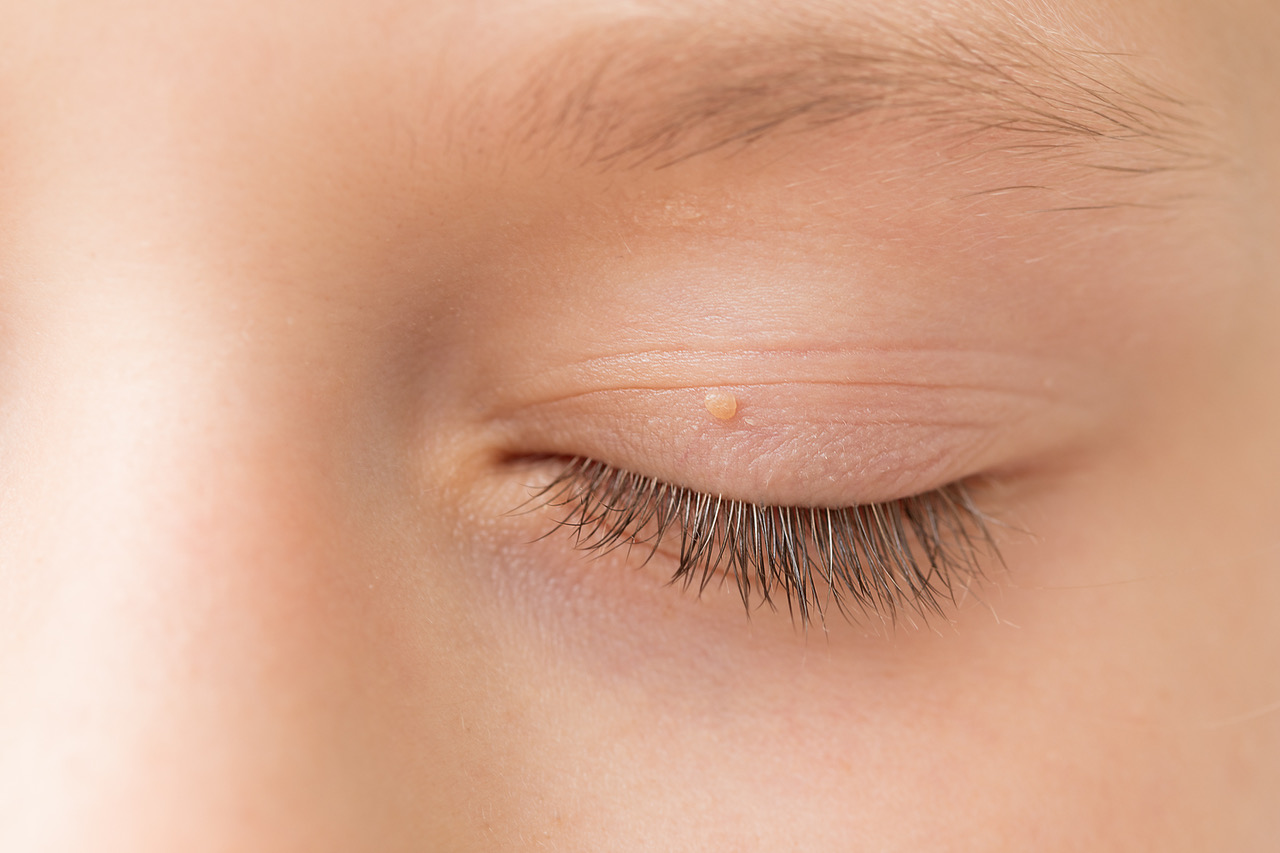 small-bump-on-eyelid